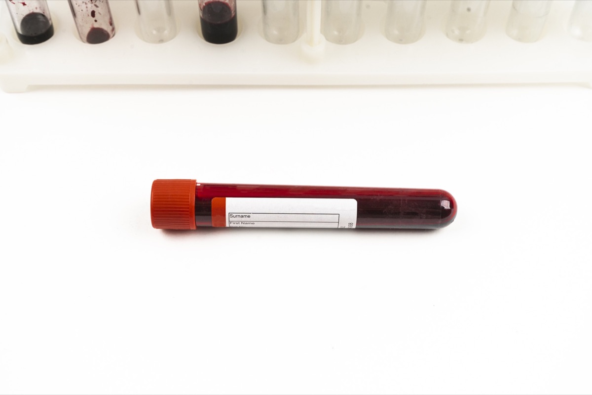 DVT (Deep Vein Thrombosis) Symptoms: When to Seek Emergency Care